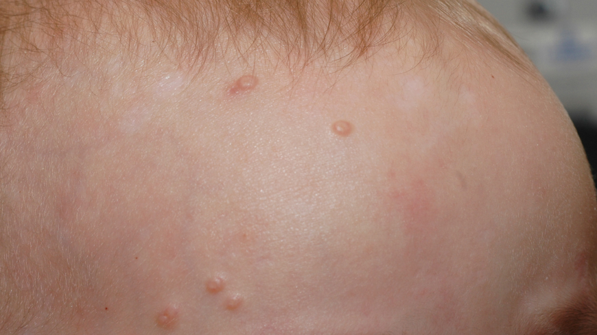 Mollusker (Molluscum contagiosum)